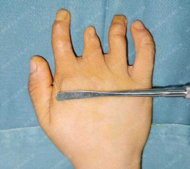 短指症手术后图片图片