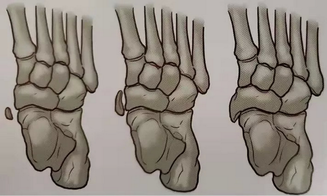 足內側突出伴疼痛警惕是不是足副舟骨