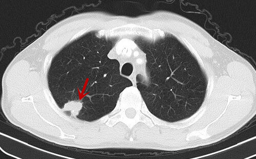 肺结节影像图 恶性图片