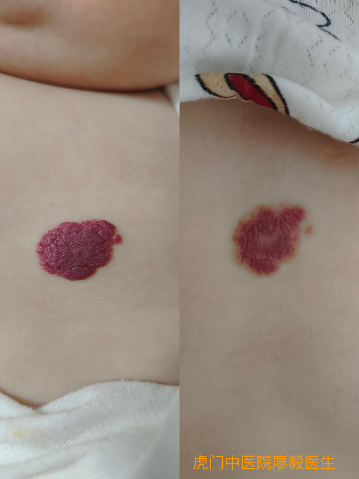 婴儿草莓血管瘤