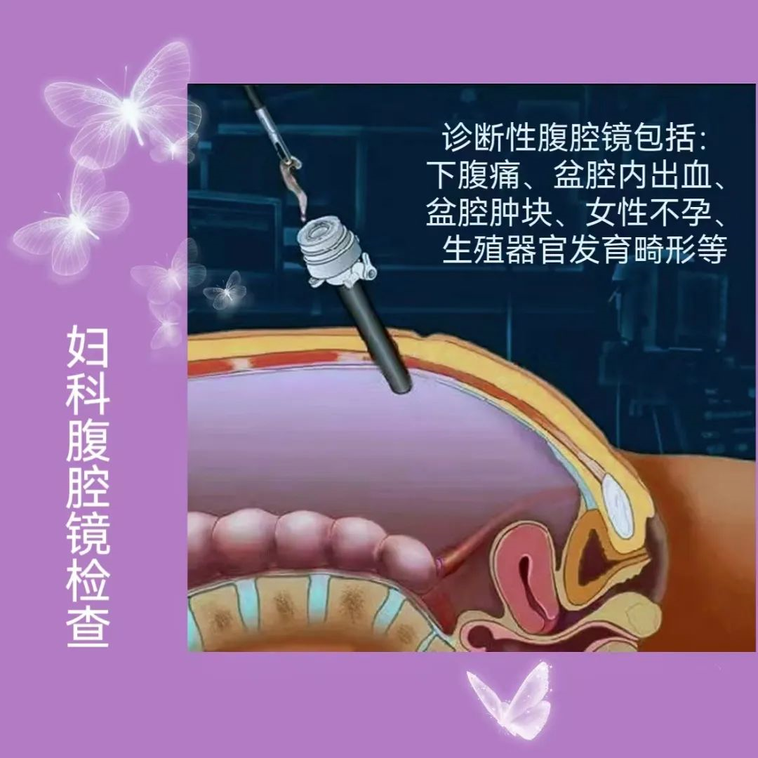 婦科腹腔鏡手術分為診斷性腹腔鏡和手術性腹腔鏡.