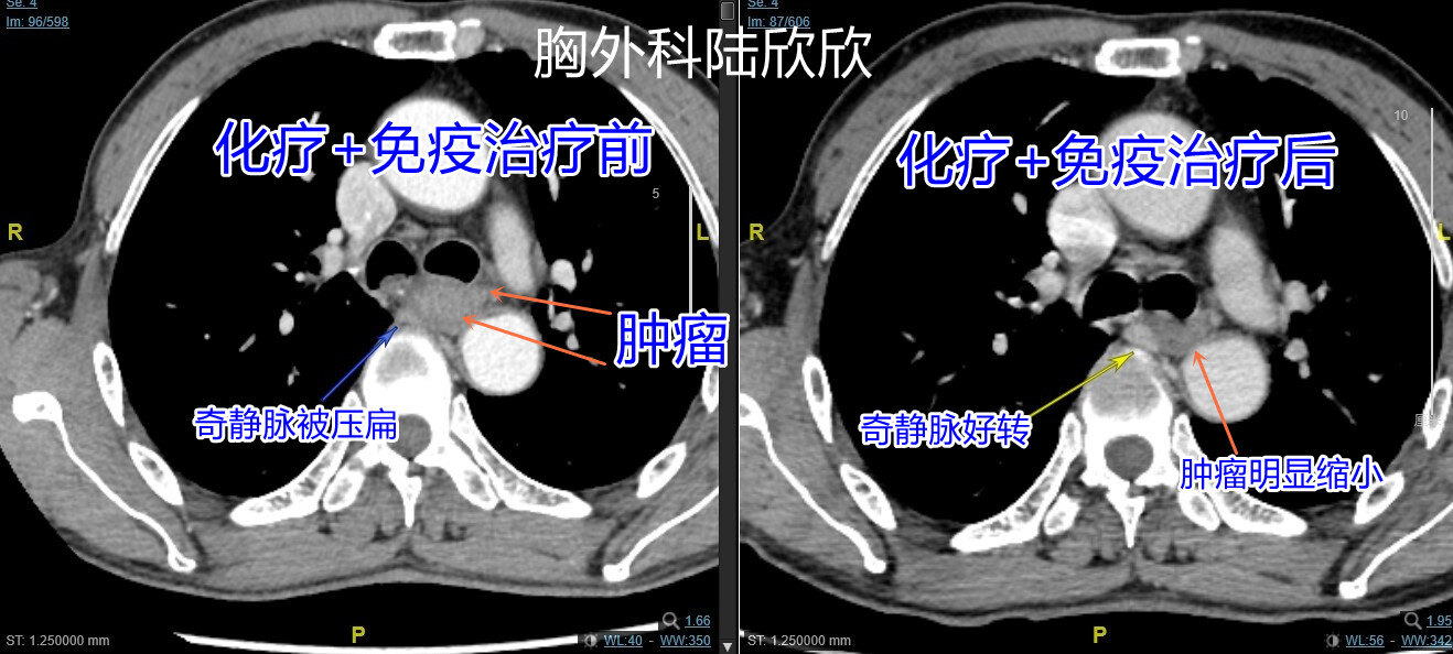 奇静脉受侵犯水印.jpg