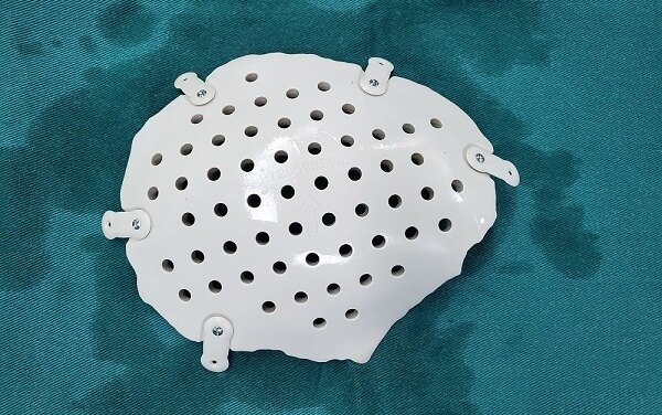 自体颅骨吸收了怎么办_颅骨修补术_颅骨修补术治疗介绍 - 好大夫在线