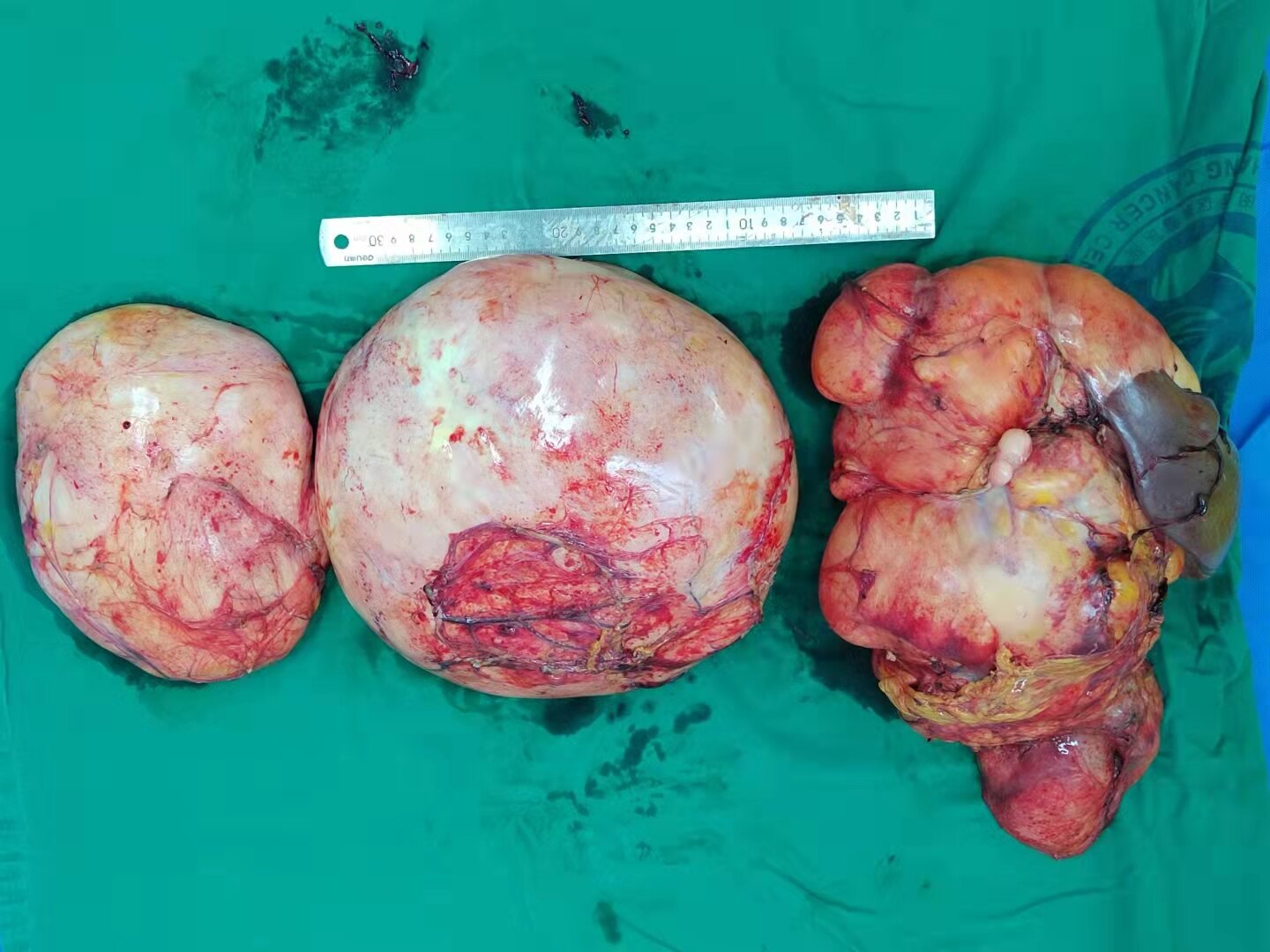 软组织肿瘤_软组织肿瘤治疗方式 - 好大夫在线