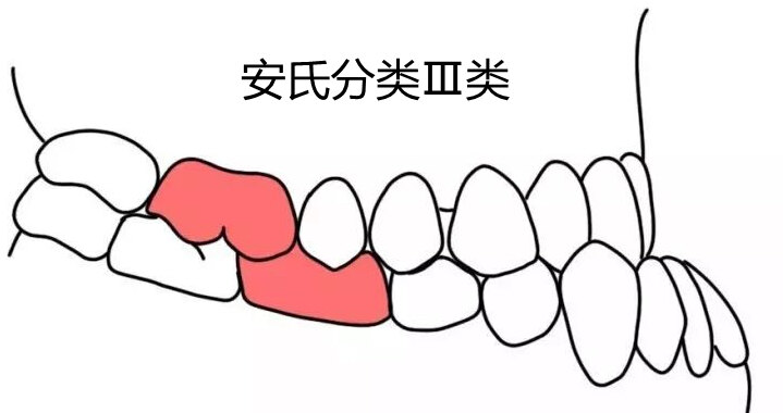 腺样体面容的安氏Ⅱ类错牙合畸形_小儿腺样体肥大_小儿腺样体肥大症状
