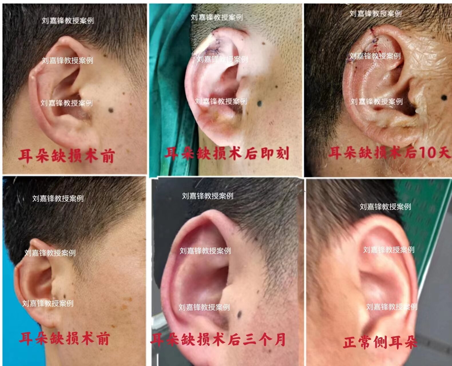 【案例分析】26岁男子耳朵受伤，做部分耳再造手术重获完好耳朵 - 哔哩哔哩