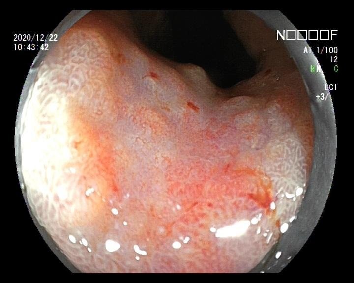 胃癌胃镜图片 彩色图片