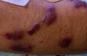 卡波西肉瘤_卡波西肉瘤_卡波西肉瘤介绍 - 好大夫在线