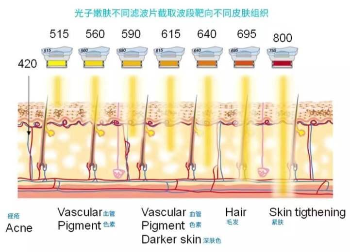 关于光子嫩肤看这一篇就够了