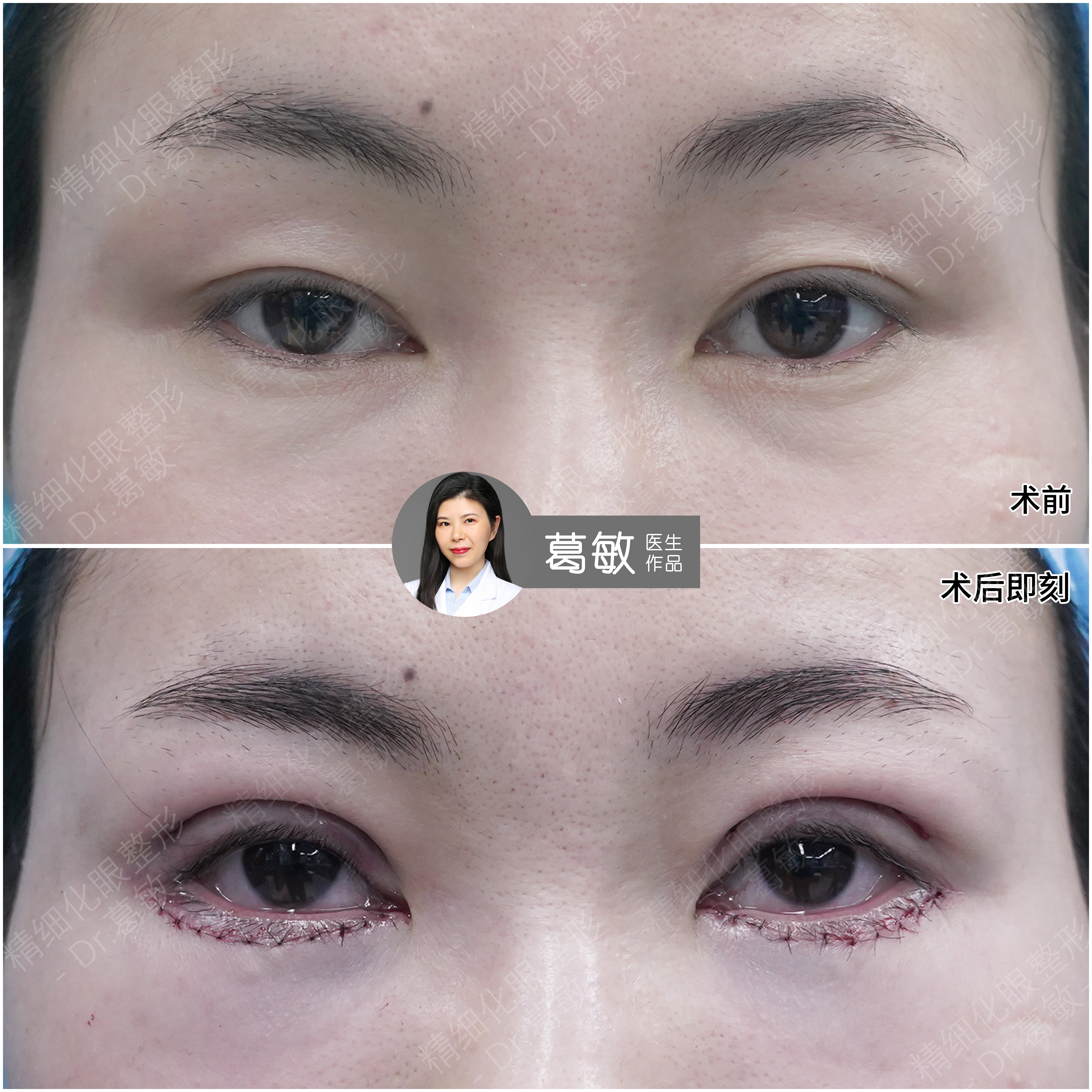 双眼皮?外切眶隔释放 - 好大夫在线