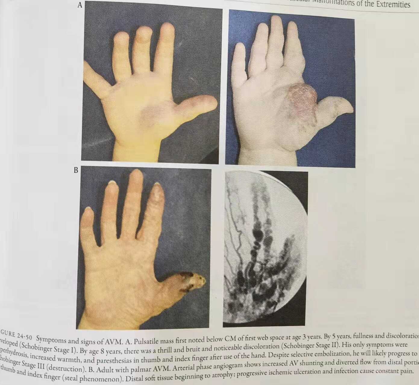 手掌动脉瘤图片图片