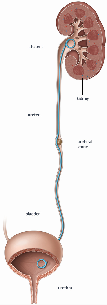 Double J-stent placement - Patient Information