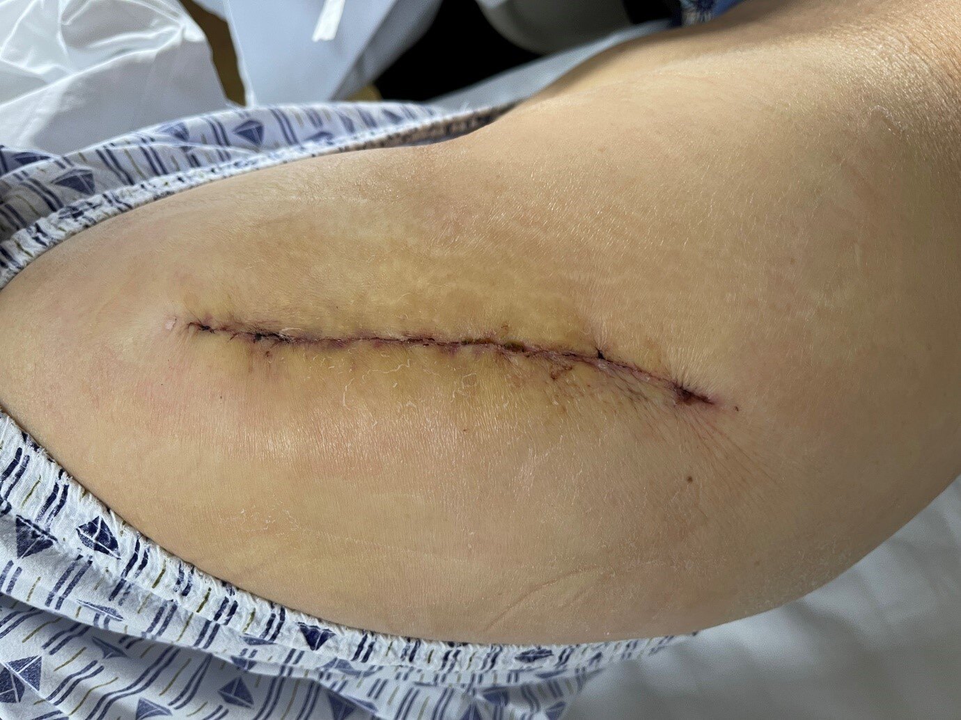 置换术后第3天拍片复查图9 术后第6个月的伤口恢复情况伤口愈合良好