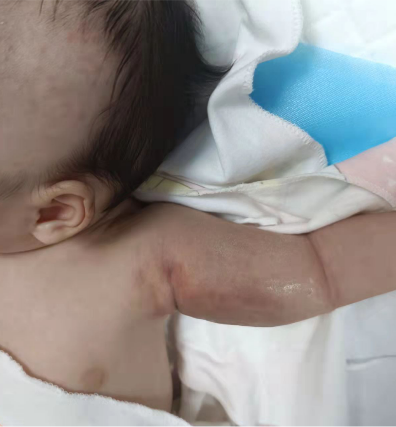 要命的"血管瘤"——卡梅综合征 - 好大夫在线