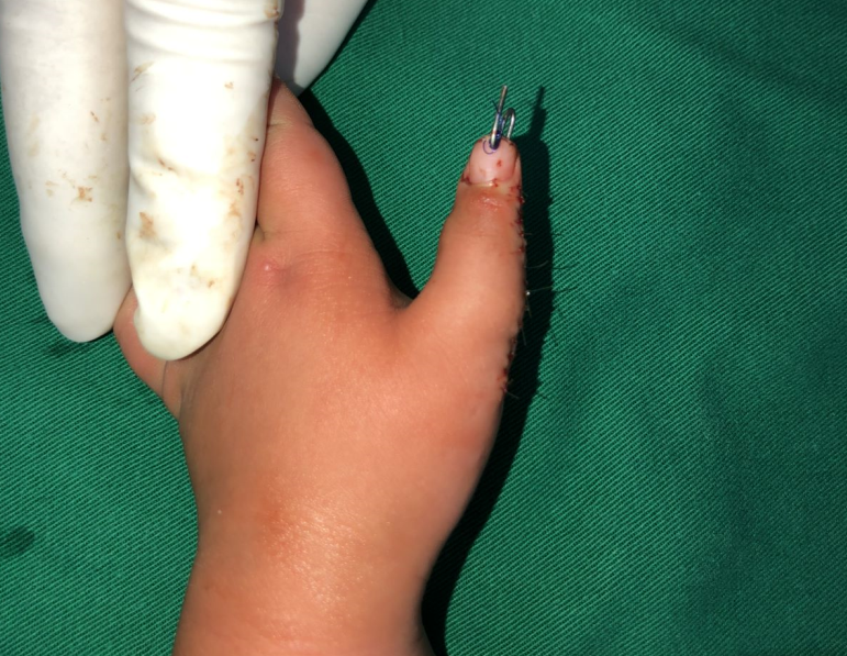 蟹钳样多指畸形矫正案例分享 - 好大夫在线