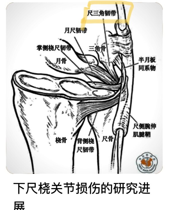 腕关节的小众疾病(尺三角韧带损伤)的自我诊断和术后