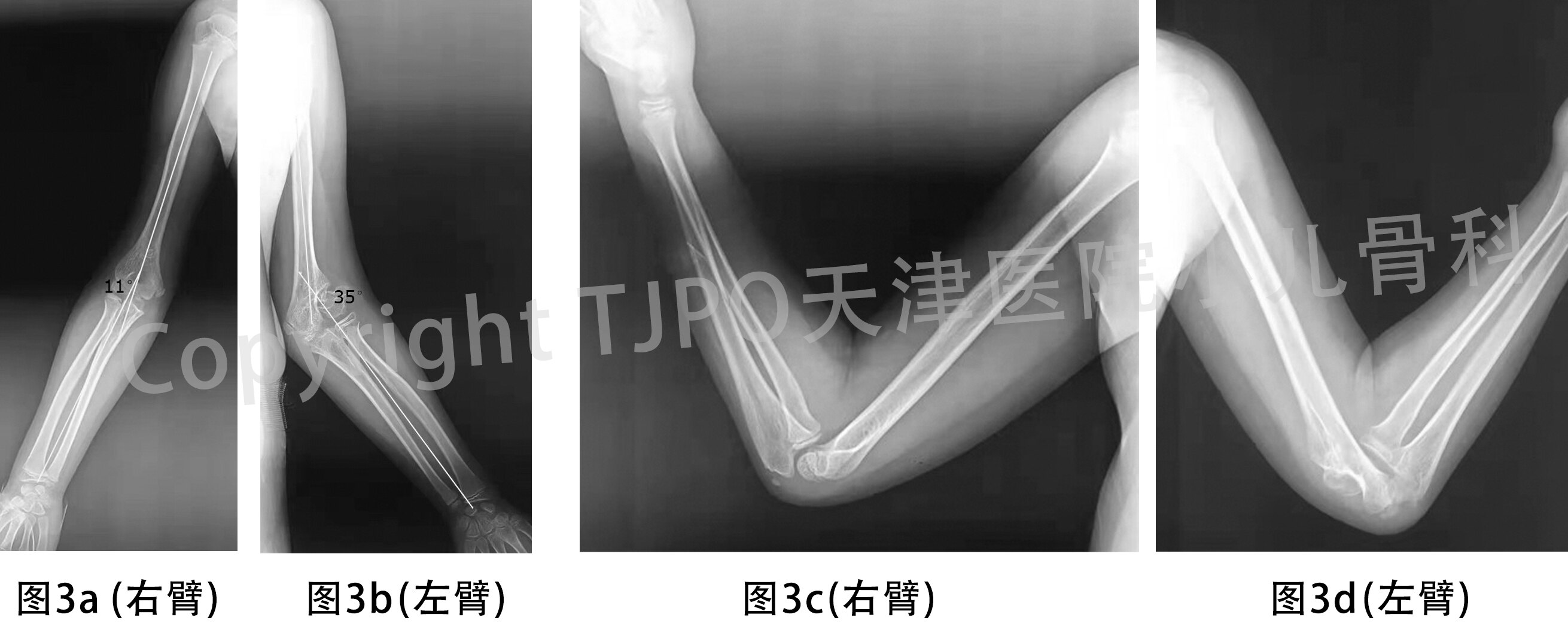 肘外翻怎么看图片