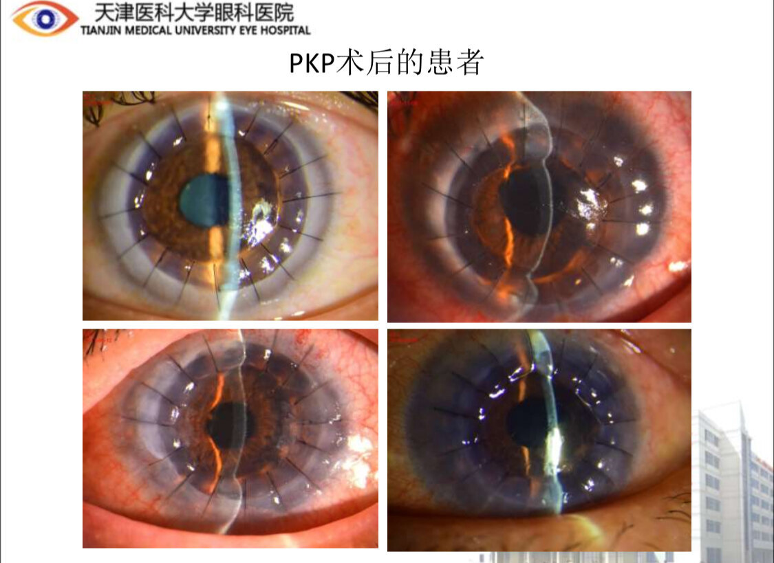 角膜移植手术的选择