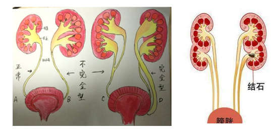 胎儿重复肾图片