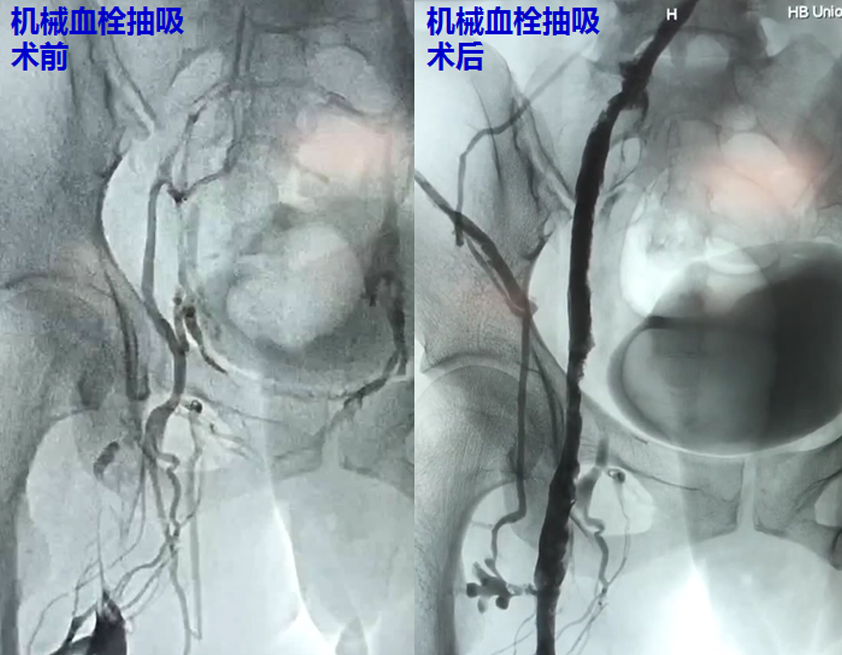 11. 机械血栓抽吸术疗效.jpg