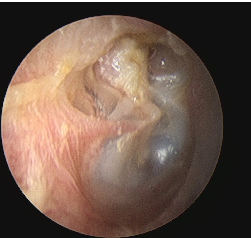 外耳道胆脂瘤图片图片