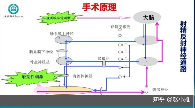 二.阴茎背神经阻断术手术原理和方法