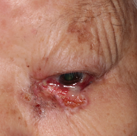 眼角乳头状瘤图片图片