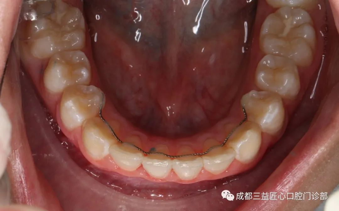 (圖片來自網絡)舌側絲保持器一般粘接在前牙的舌側而起固定作用.