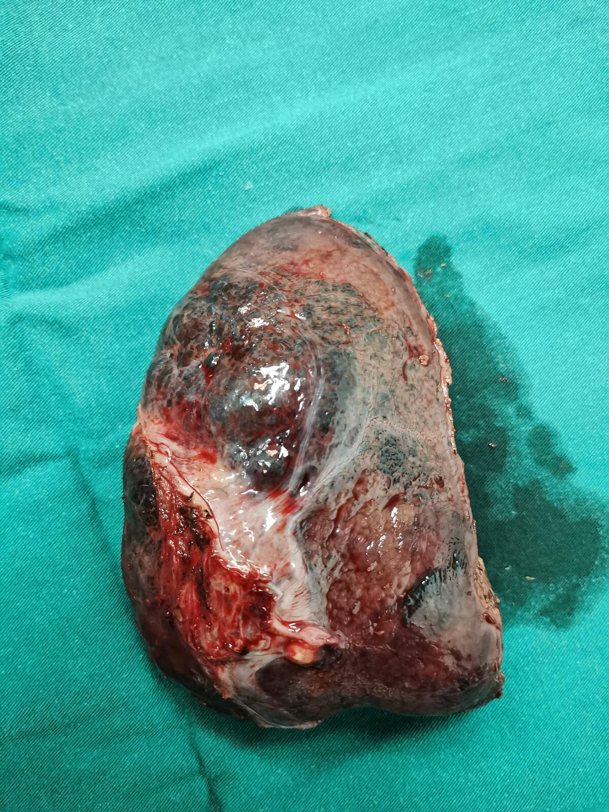 肝血管瘤6cm图片图片