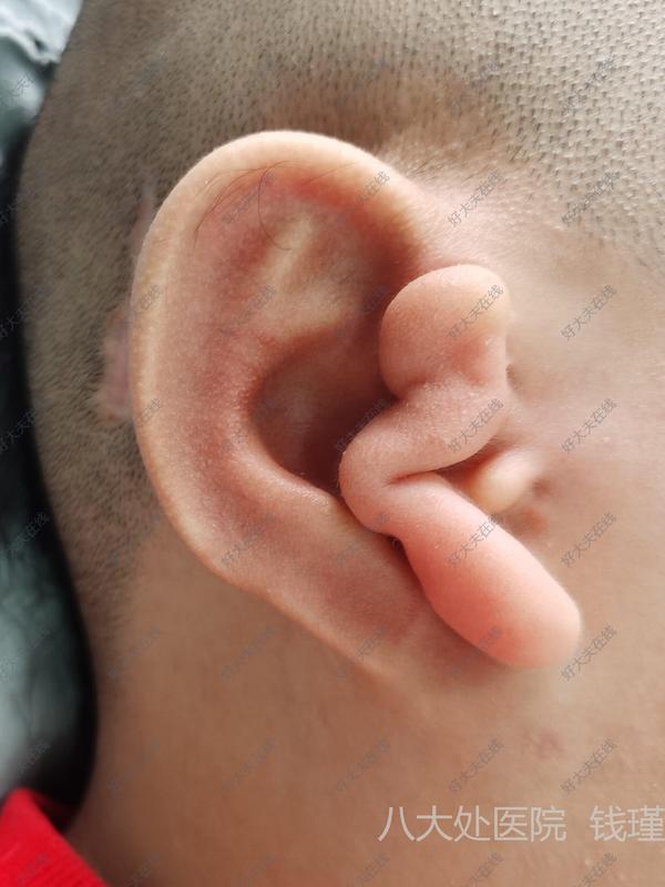 8岁男孩,小耳畸形,肋软骨耳再造二期术后半年,再造耳形态良好治疗后