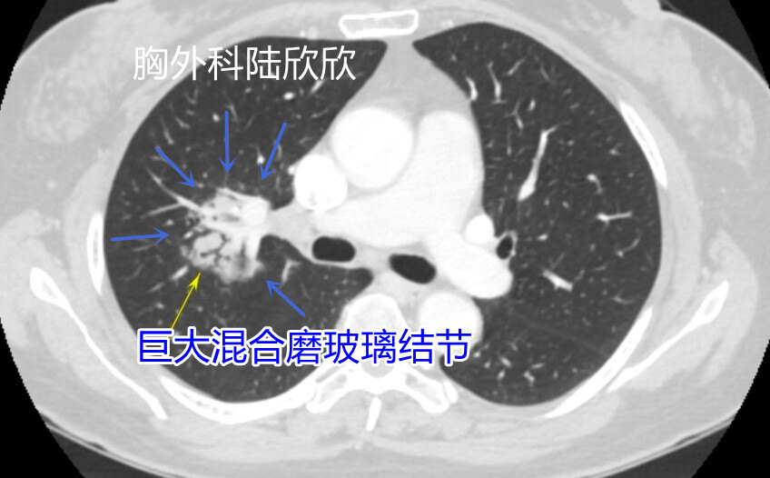 扭曲僵硬支气管水印.jpg