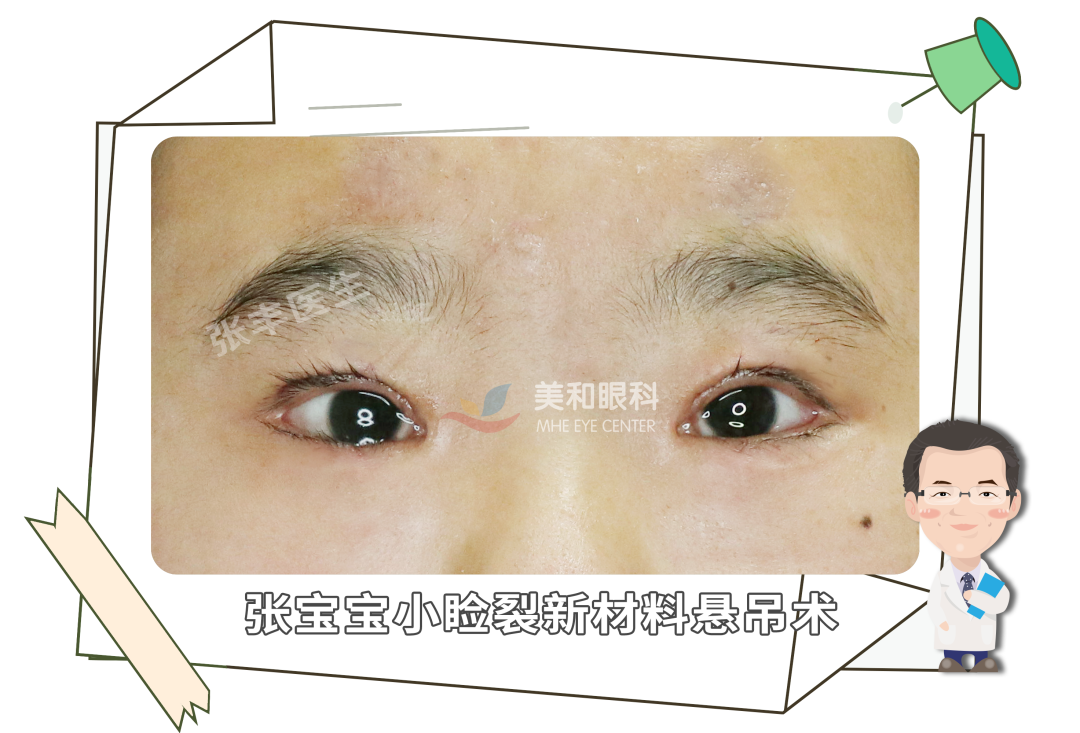 小睑裂综合征漫漫求医路_小睑裂_小睑裂治疗方式 - 好大夫在线