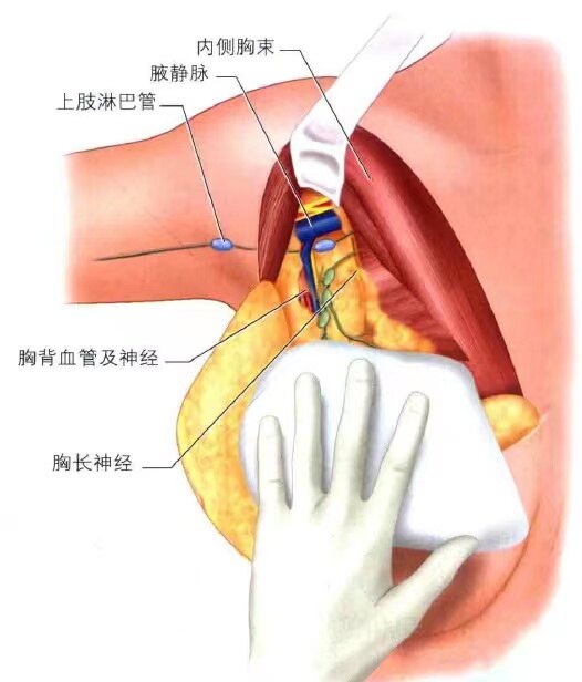 可見腋靜脈圖8 可見背闊肌及胸小肌圖7 乳腺癌手術體表及深部切緣圖6