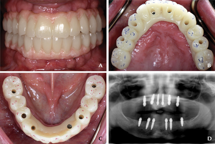 A-Complete-arch-implant-supported-fixed-interim-prostheses-in-centric-occlusion-B.png