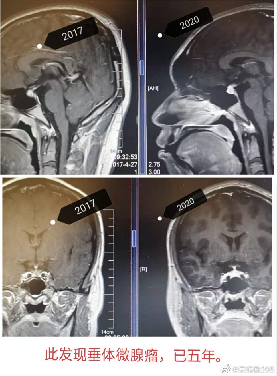 脑垂体微腺瘤图片