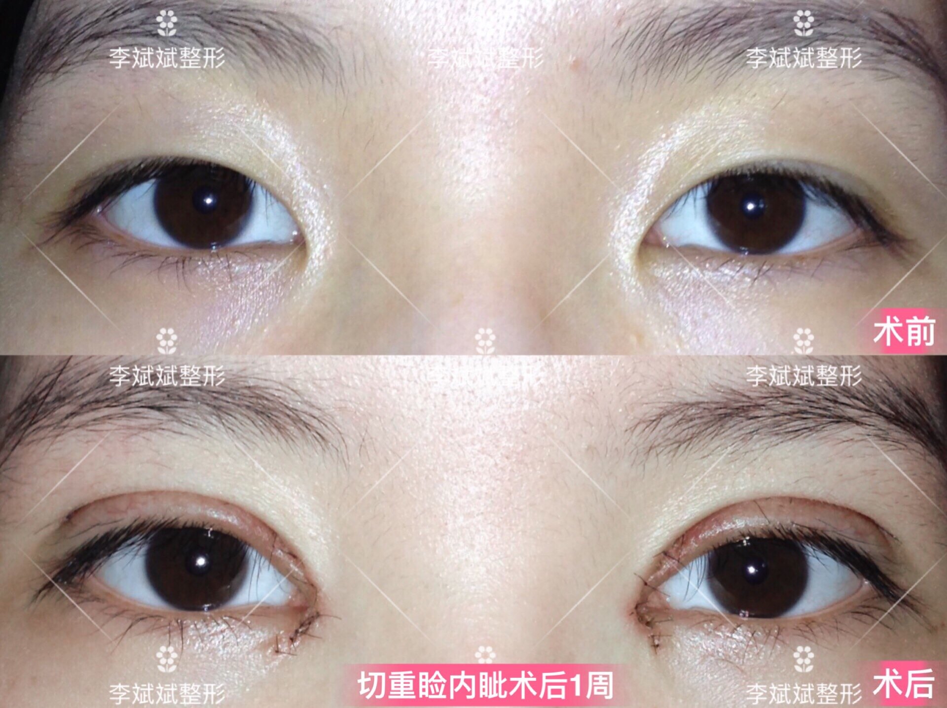 【双眼皮】双眼皮 开内眼角案例合集_双眼皮手术_双眼皮手术治疗介绍