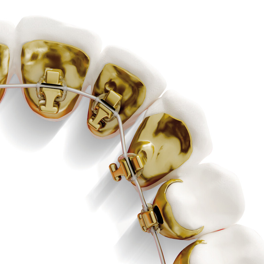 舌侧托槽粘接后注意事项 _正畸_正畸治疗方式 - 好大夫在线