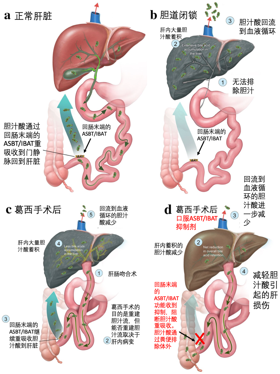 ASBT/IBAT抑制剂治疗Alagille综合征、PFIC、葛西术后及硬化性胆管炎等难治性胆汁淤积_原发性硬化性胆管炎 - 好大夫在线