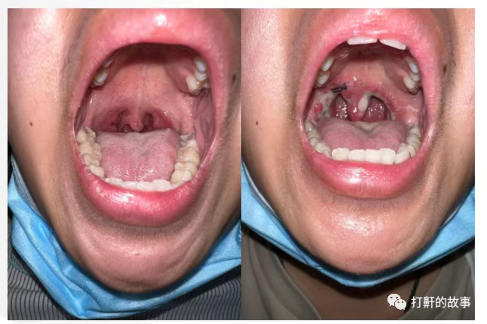 狭窄)成人:最常见的狭窄部位在口咽平面,包括扁桃体肥大,软腭肥厚下垂