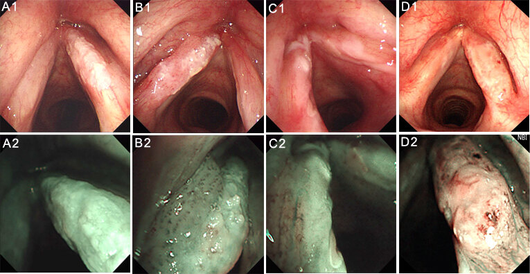 普通白光内镜下很难鉴别声带白斑的良恶性,nbi喉镜有助于鉴别诊断