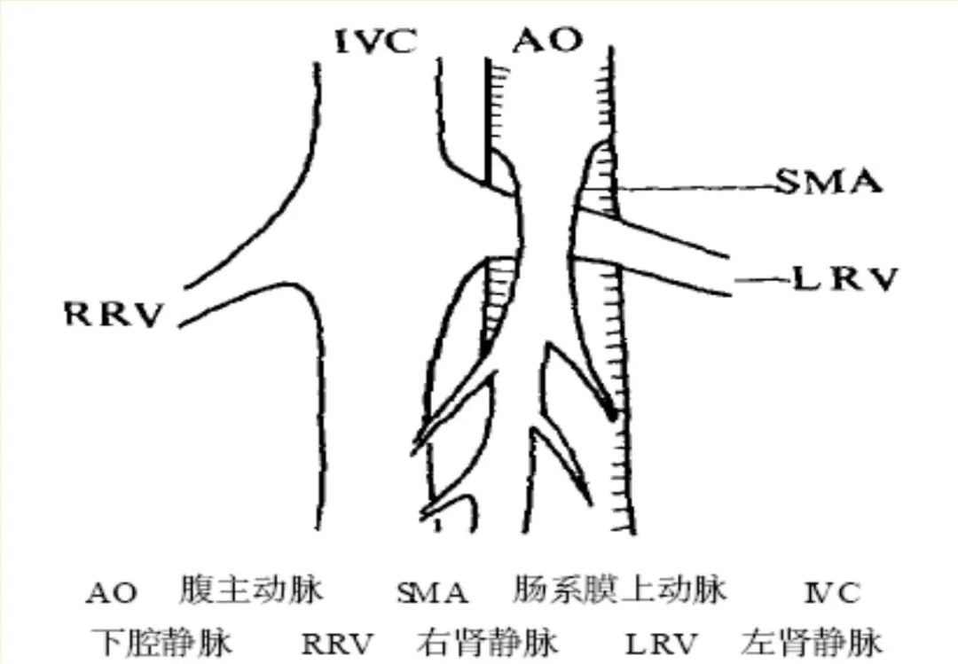一例胡桃夹综合征