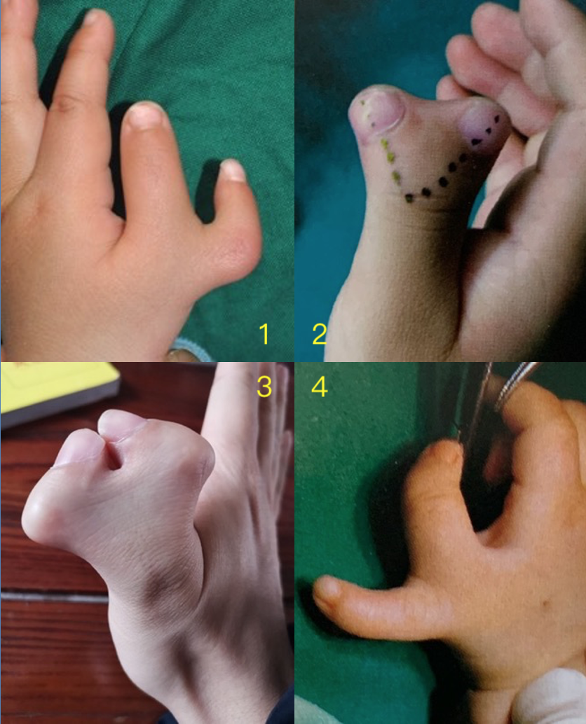 手指畸形矫正前后图片图片