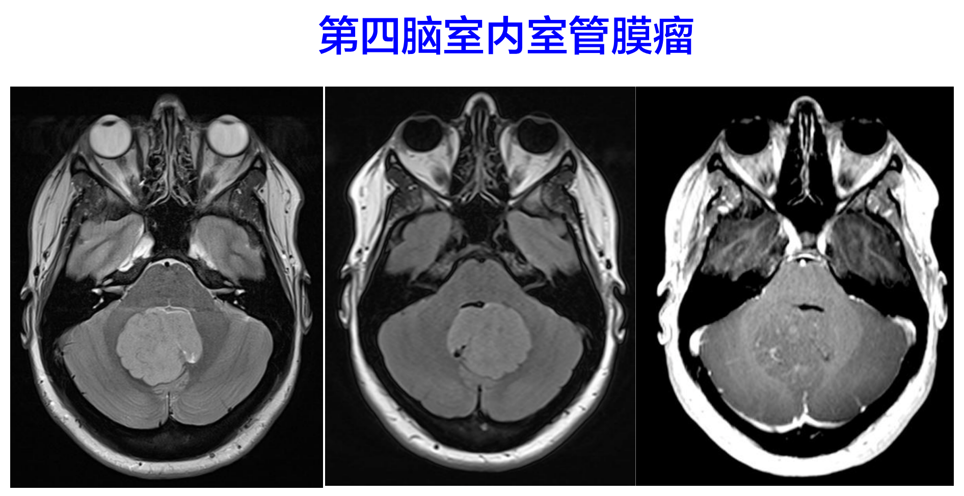 第四腦室內室管膜瘤.png