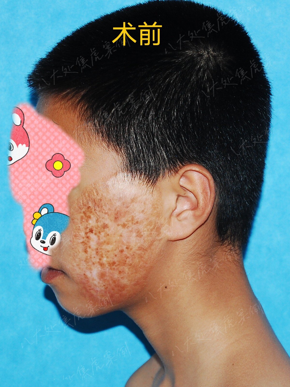 扩张器治疗瘢痕,巨痣,血管瘤等案例(持续更新中) - 好大夫在线