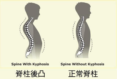青少年驼背的危害图片