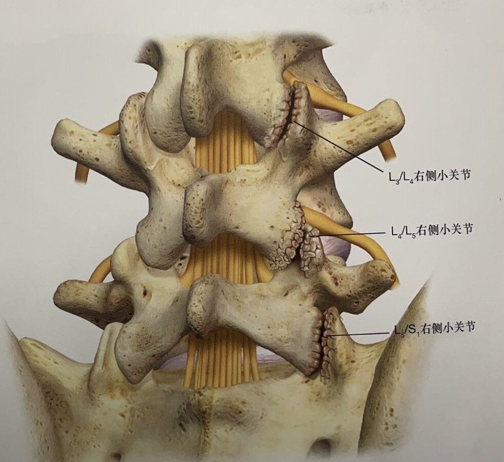 椎间小关节病变jpg