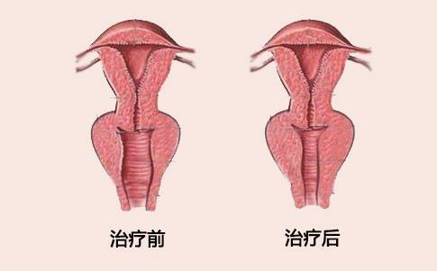 阴道变宽大会导致尿道,膀胱,直肠膨出,张力性尿失禁,排尿困难,反复
