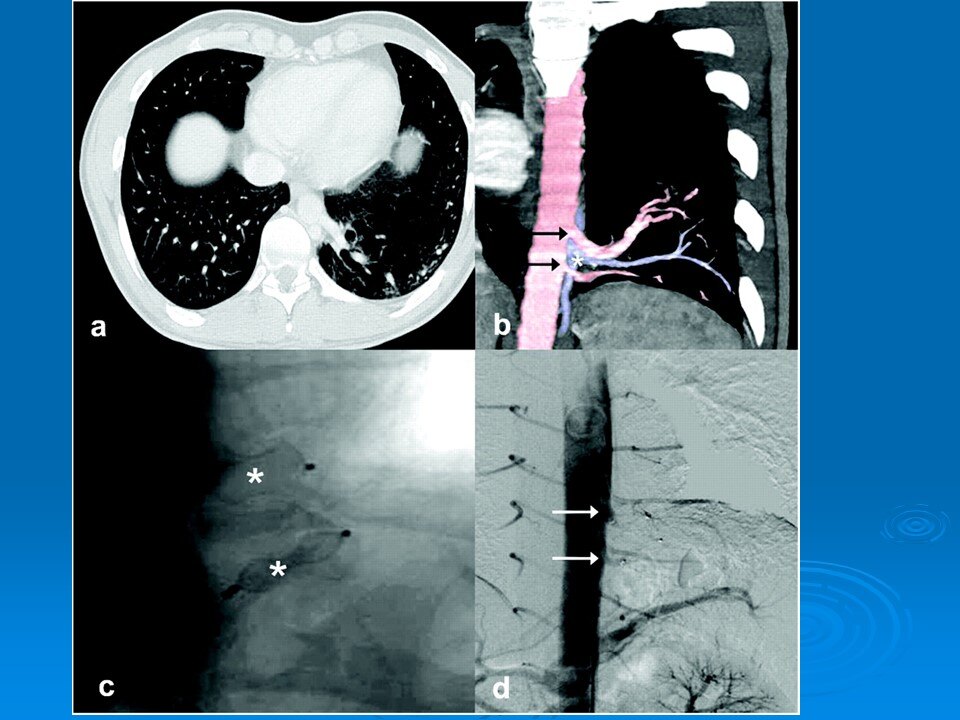 肺隔离症 先天性图片