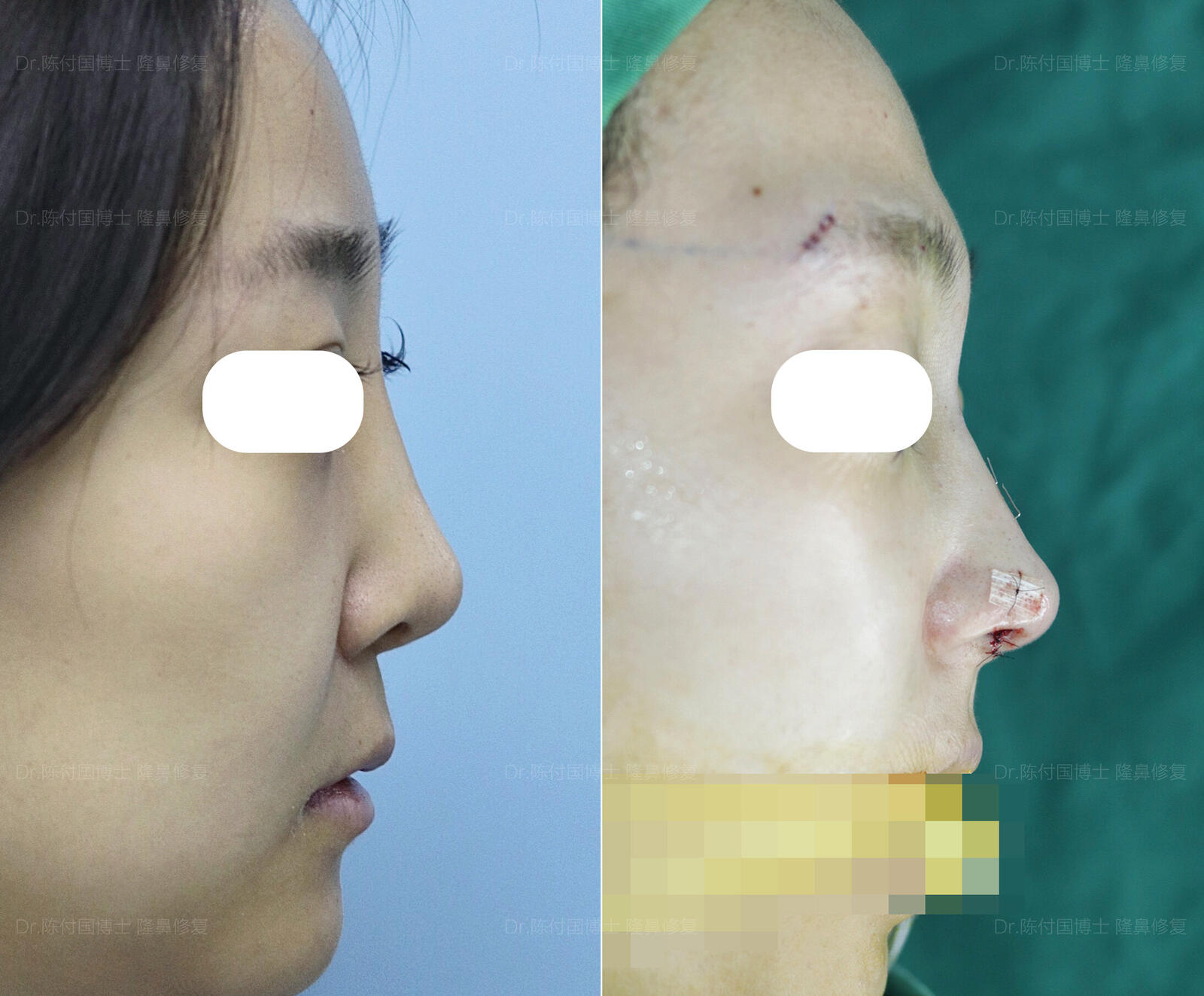 唇裂鼻畸形修复核心问题之：什么时候手术修复最佳？_李超__爱问健康