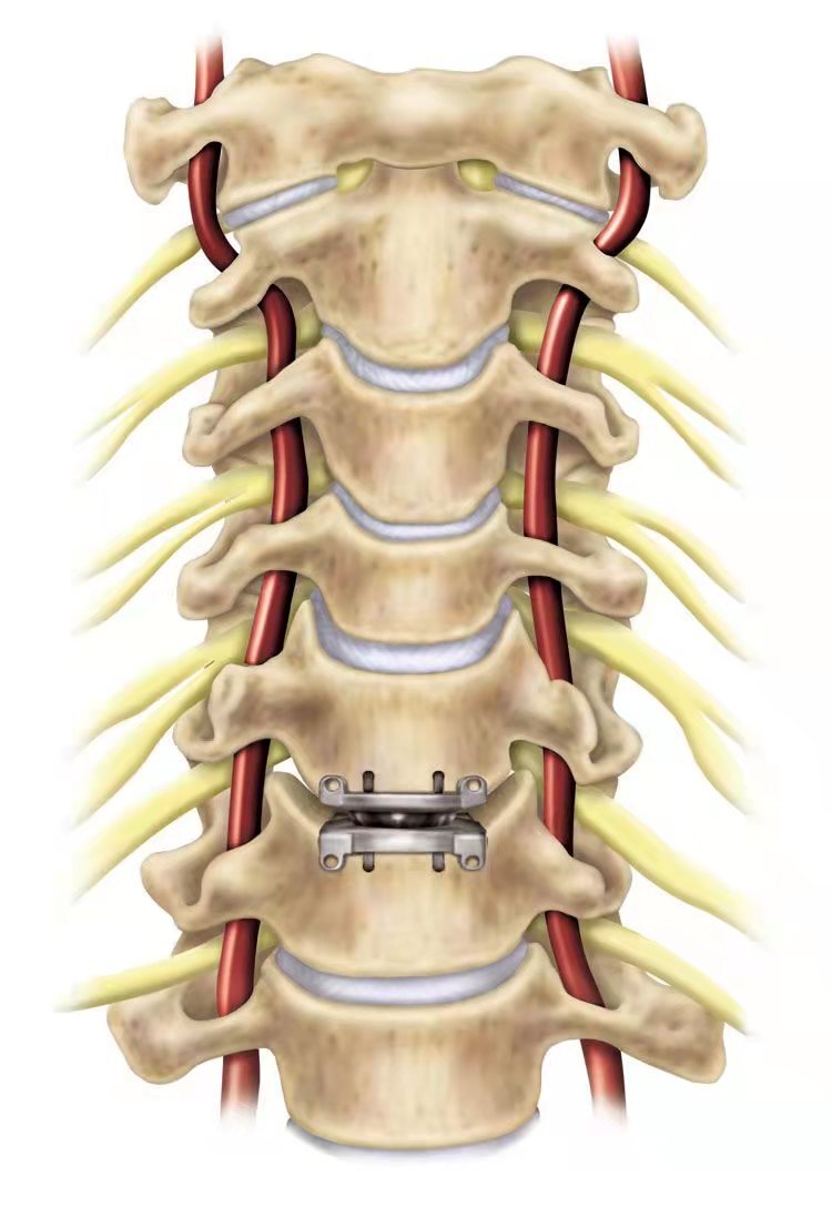 人工椎间盘图片
